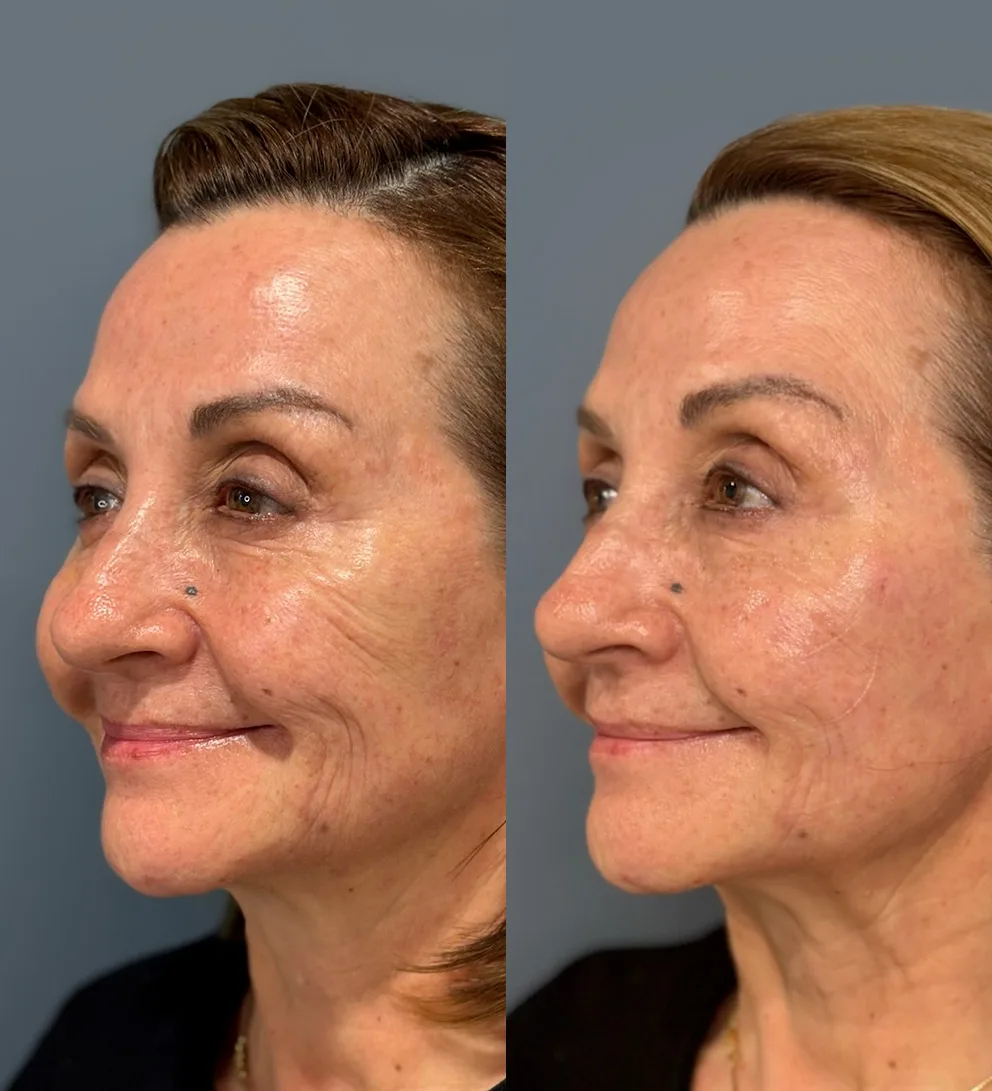 Skinvive™ Skinboost hidratación profunda