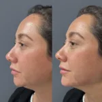 Portada AD menton perfil