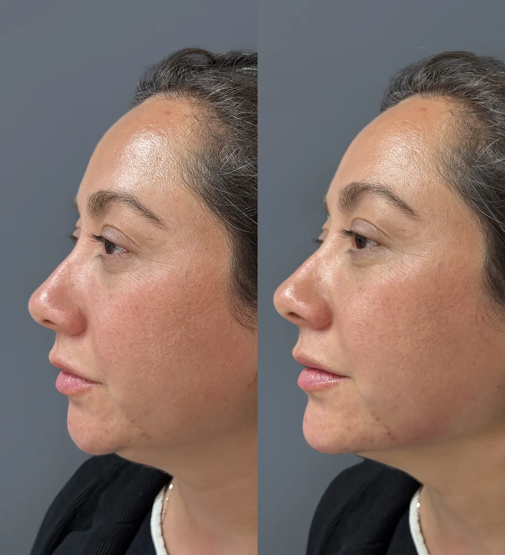 Relleno de mentón con ácido hialurónico Teoxane®