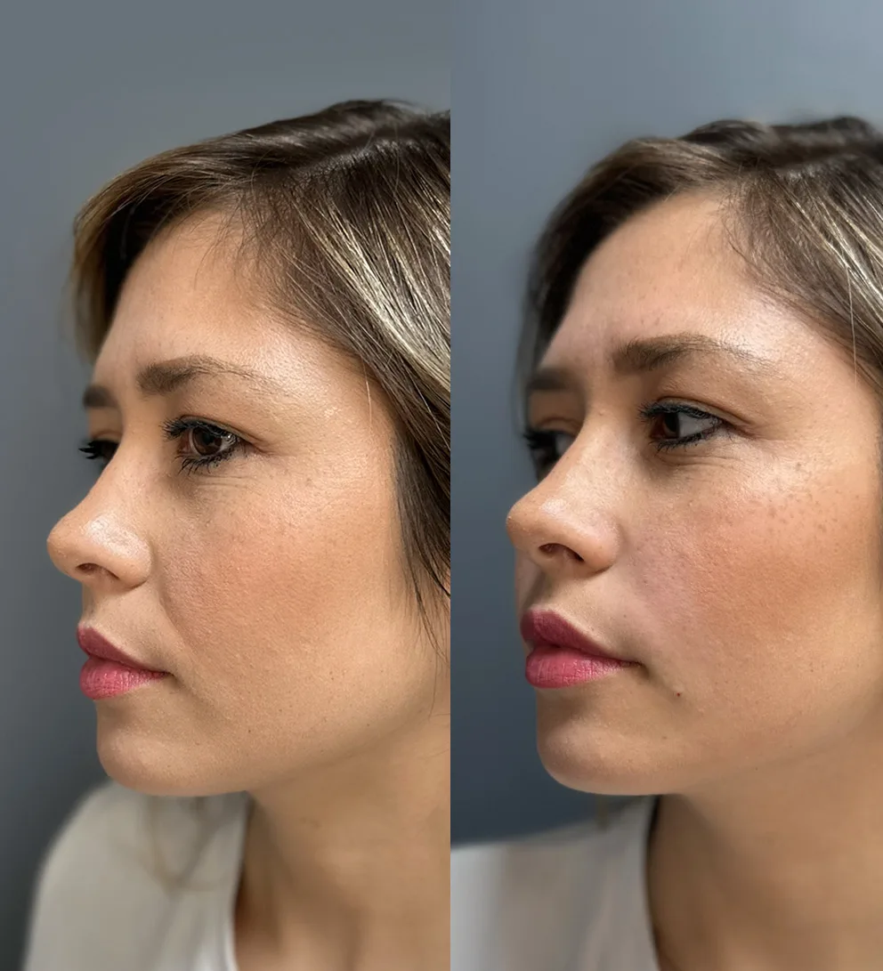 Relleno surco nasogeniano con ácido hialurónico Teoxane®