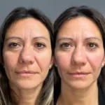 Portada AD relleno pomulos