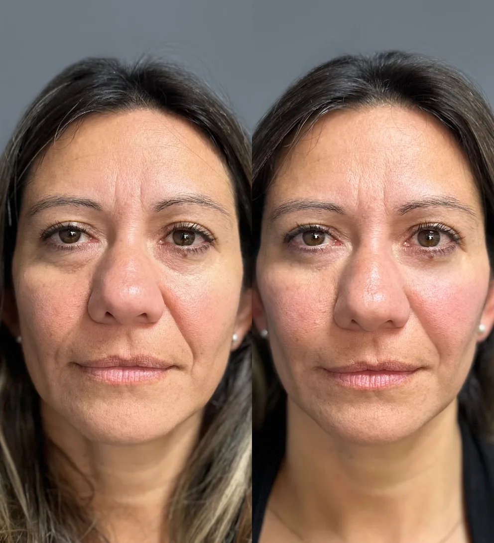 Relleno de pómulos con ácido hialurónico Teoxane®