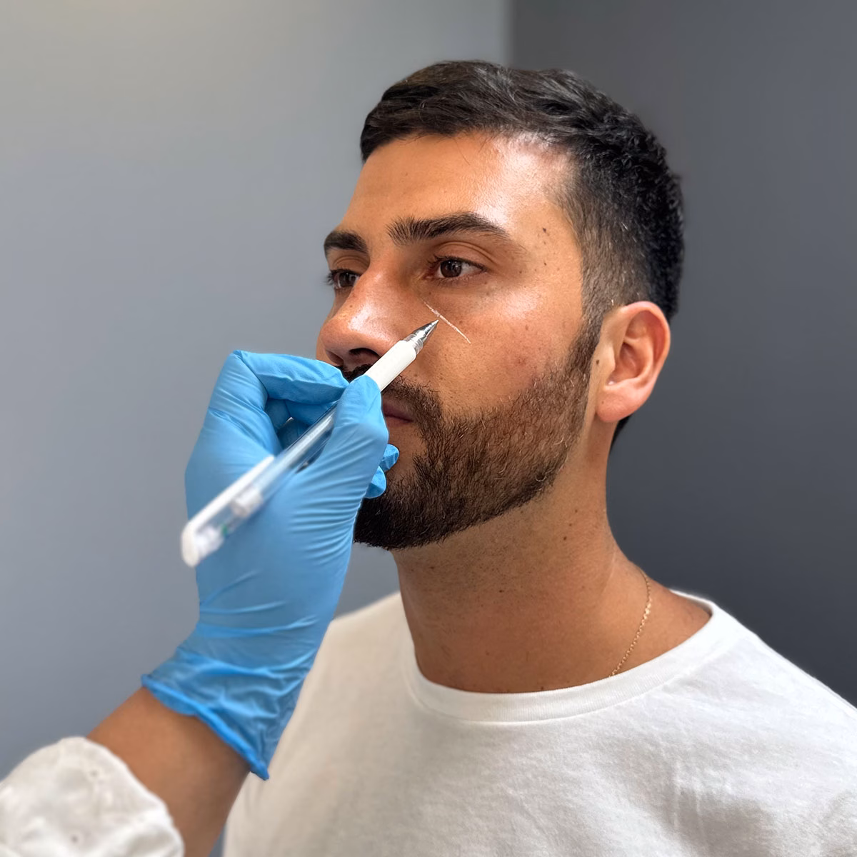 Ojeras: 5 errores comunes al elegir un tratamiento y cómo evitarlos