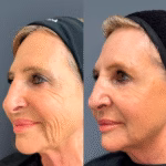 Sculptra® bioestimulación facial 1 sesión 2 Sculptra® tratamiento de bioestimulación facial con ácido poli-L-láctico
