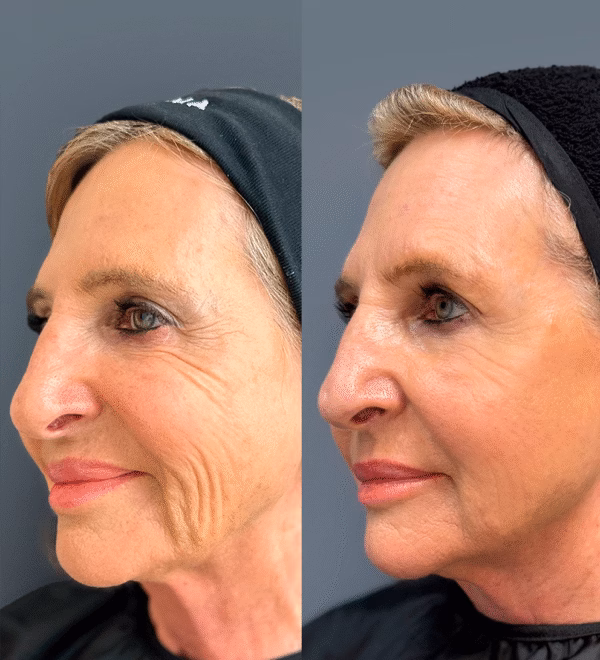 Sculptra® tratamiento de bioestimulación facial con ácido poli-L-láctico