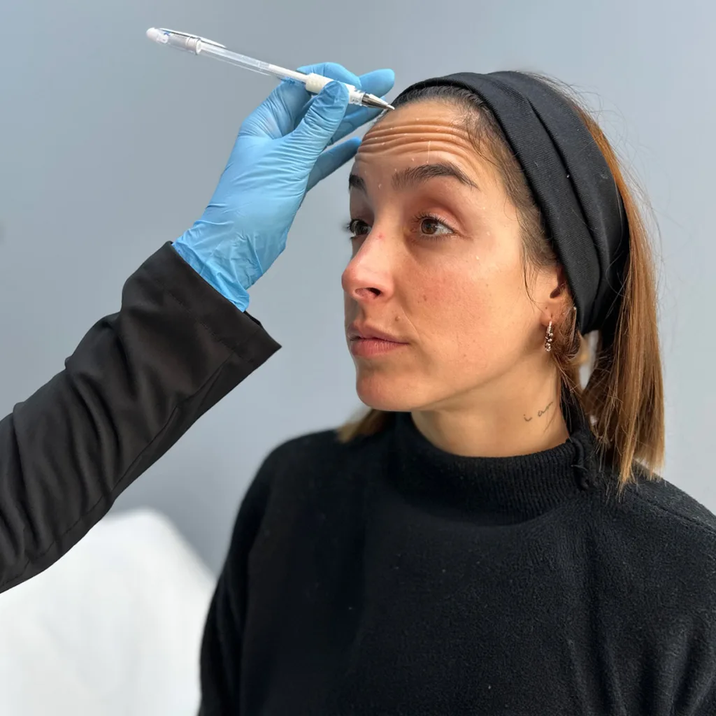 Aplicación segura de Botox en Santiago en Clínica EM