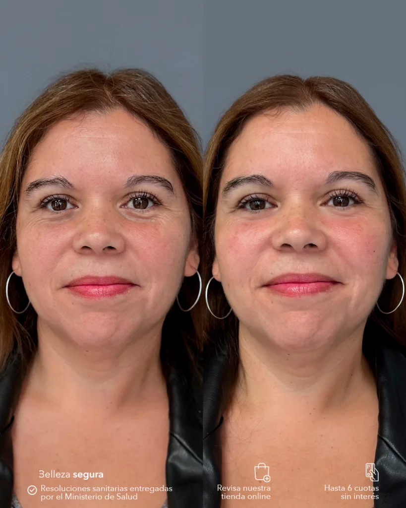 Cómo quitar las ojeras: la guía definitiva para una mirada descansada 1 Reducción de ojeras en Clínica EM