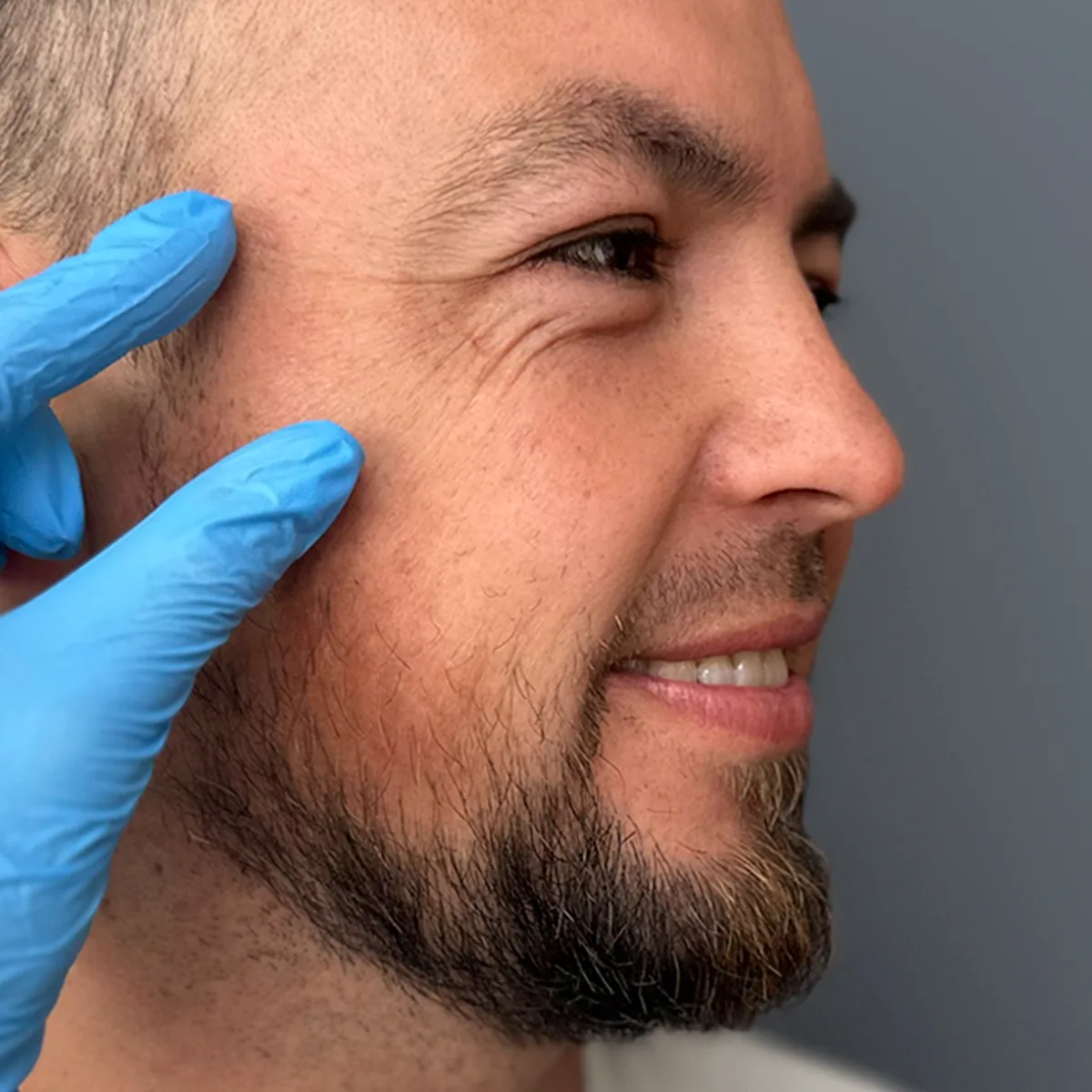 Botox: qué músculos intervienen y cómo actúa en cada zona del rostro