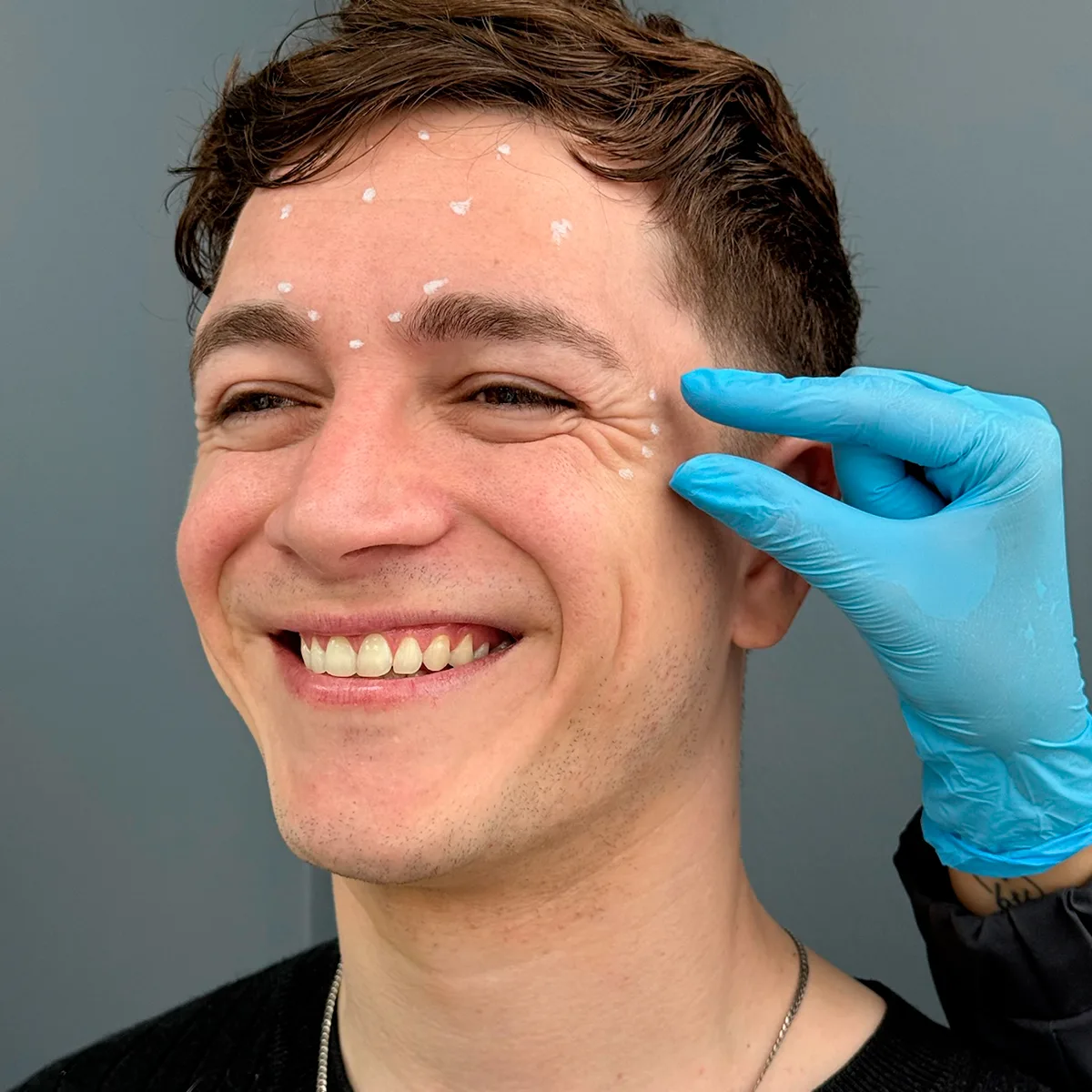 Vacaciones sin arrugas: el poder del Botox para un verano con piel fresca