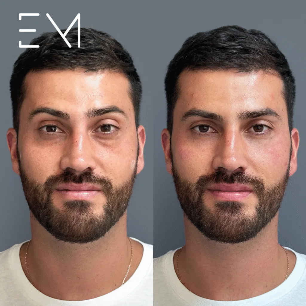 Tipos de ojeras y cómo se tratan según la causa real 1 ojeras antes y después