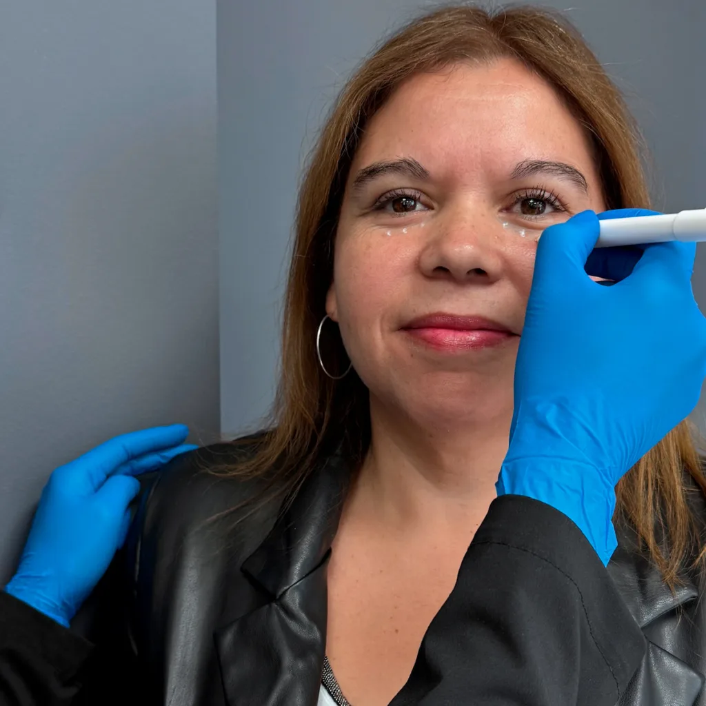 relleno-de-ojeras-acido-hialuronico-clinica-em