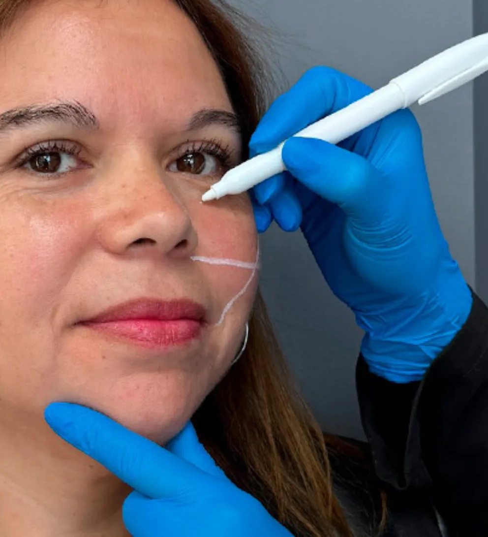 Relleno de ojeras: indicaciones, contraindicaciones y recomendaciones