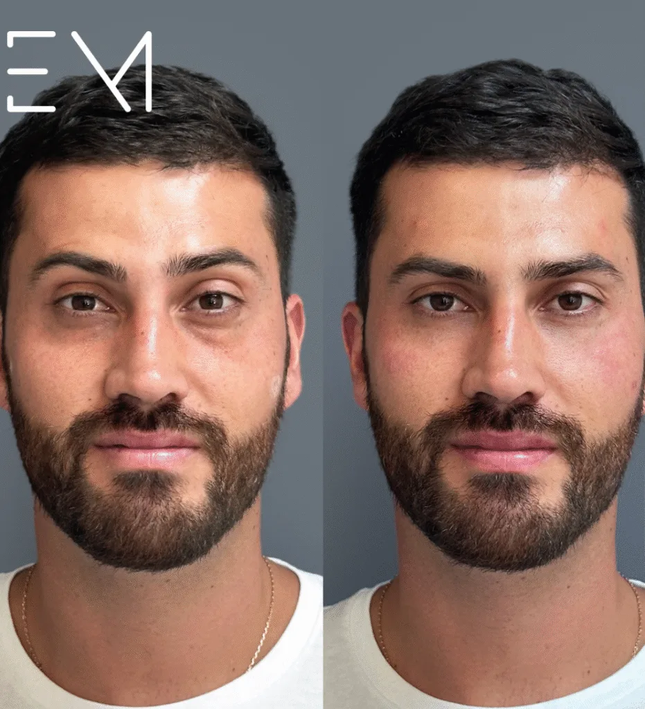 Relleno de ojeras: indicaciones, contraindicaciones y recomendaciones 1 Relleno de ojeras: cuándo es indicado y cuándo no