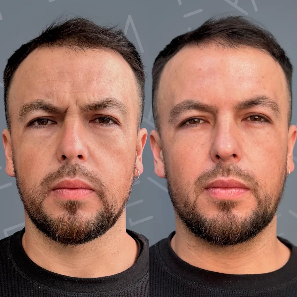 Toxina botulinica: 3 claves para entender sus efectos hoy 1 toxina botulinica