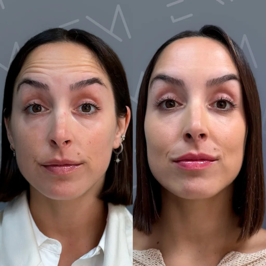 Botox en mujeres vs hombres: diferencias en dosis, técnica y resultados 1 AD Victoria Botox frente