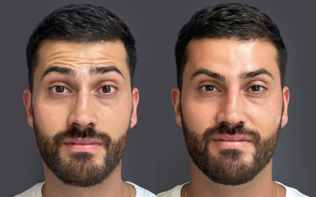 Toxina botulínica (“botox”) en Concepción: 7 claves esencial 1 Toxina botulínica (“botox”) en Concepción: 7 claves esencial