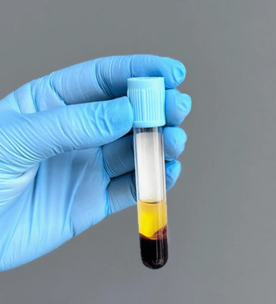 PRP Plasma Rico en Plaquetas: evidencia, usos y resultados