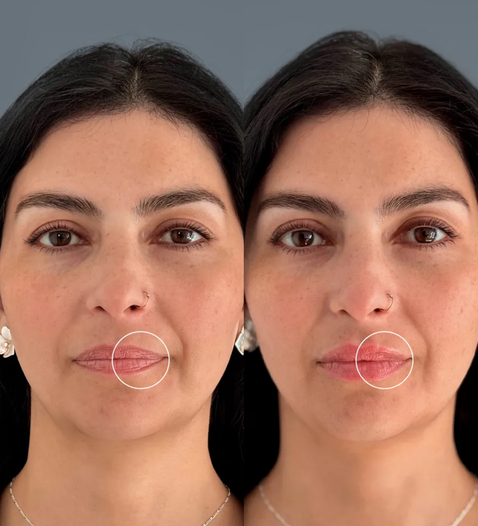 ¿Cómo definir labios con ácido hialurónico? 5 claves útiles 1 definir labios con ácido hialurónico