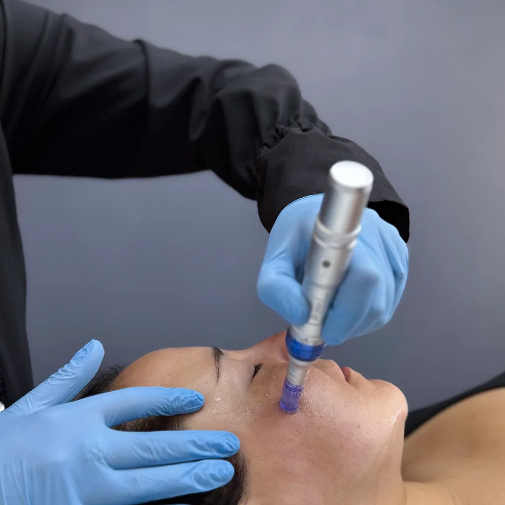 Mesoterapia: qué es, cómo funciona y cuándo se recomienda 1 mesoterapia