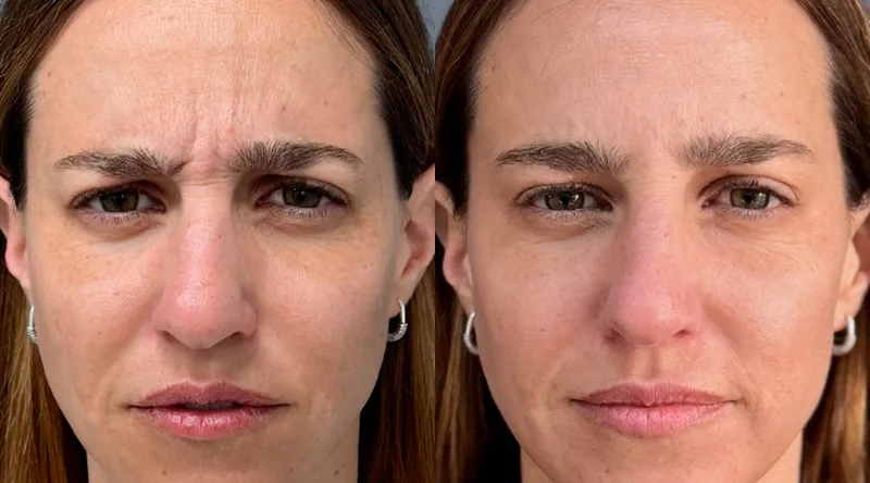 Botox para arrugas: por qué es el tratamiento Nº1 para rejuvenecer tu expresión 1 botox para arrugas