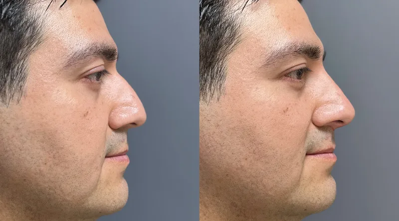 Qué esperar en tu primera sesión de rinomodelación paso a paso 1 antes y despues rinomodelacion