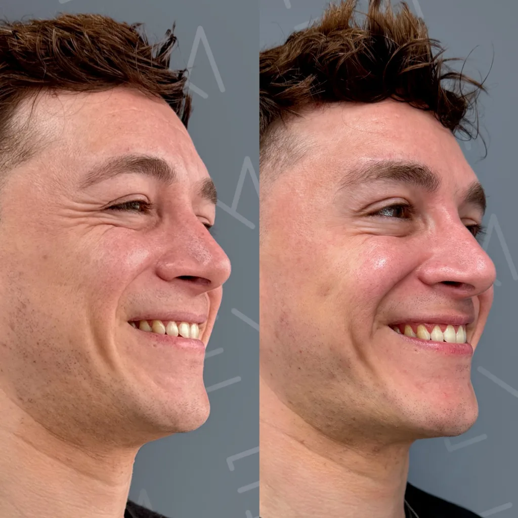 AD botox Lukas patas der