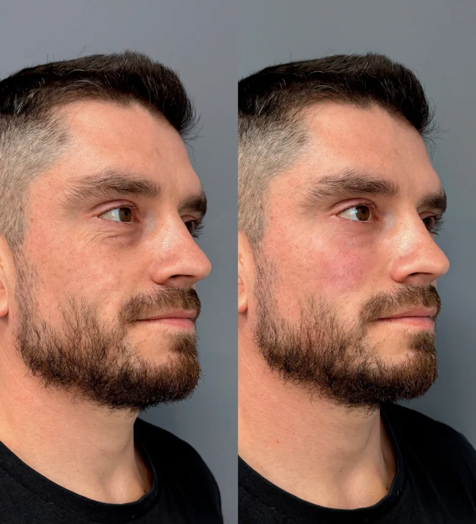 tercio medio del rostro