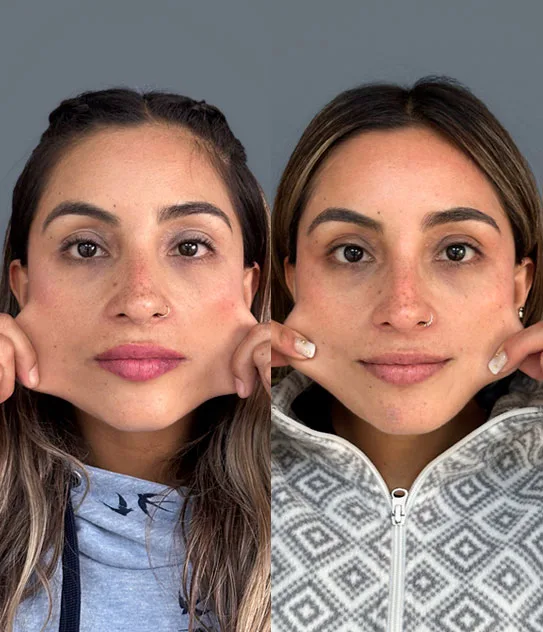 Black Friday en estética facial: cómo combinar tratamientos de forma segura 3 Portada AD Bio Pilla