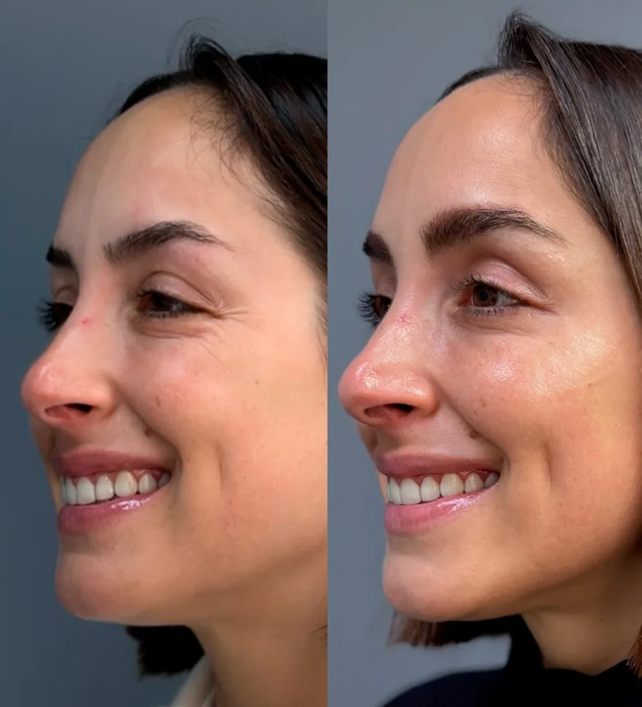 eliminar arrugas por deshidratacion con toxina