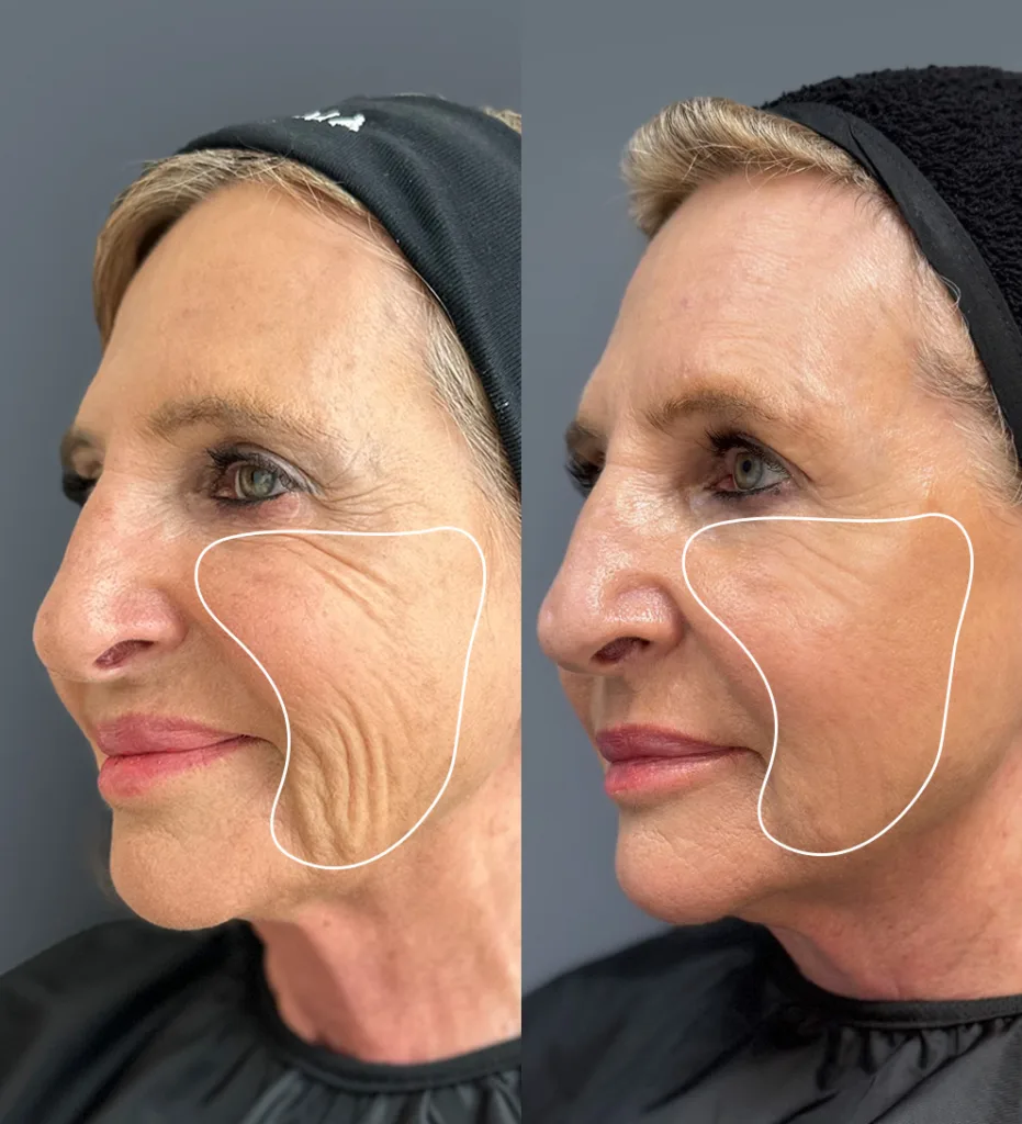 Portada AD Sculptra mujer 1