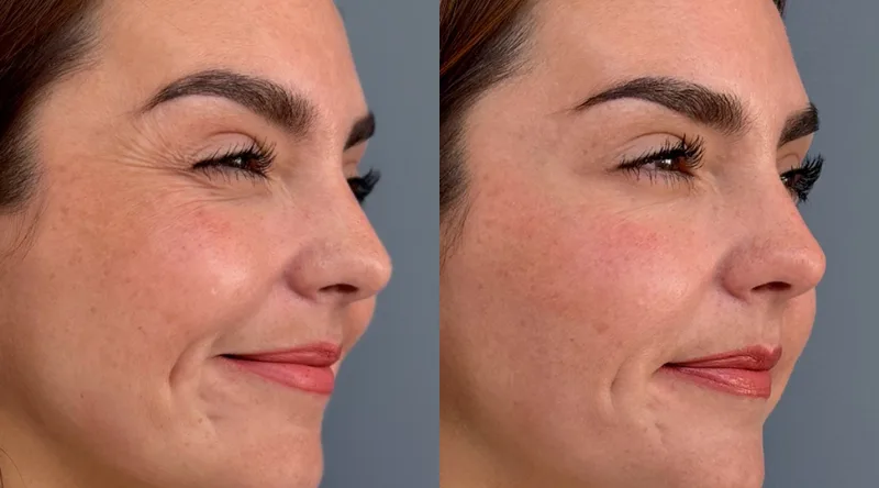 Resultados naturales del botox en Cyber 2025 Clinica EM 1