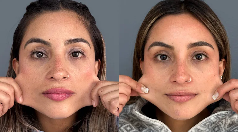 antes despues bioestimulador pilla