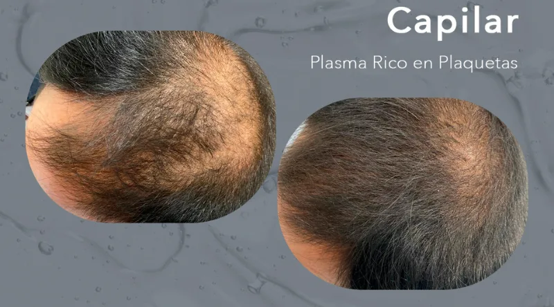 PRP capilar: qué es, para quién sirve y resultados reales 1 antes y despues prp capilar