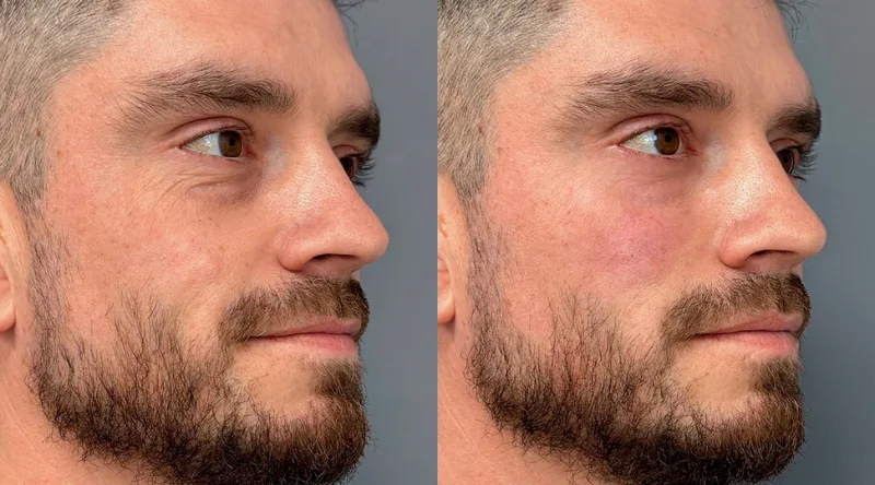 antes y despues relleno malar 1