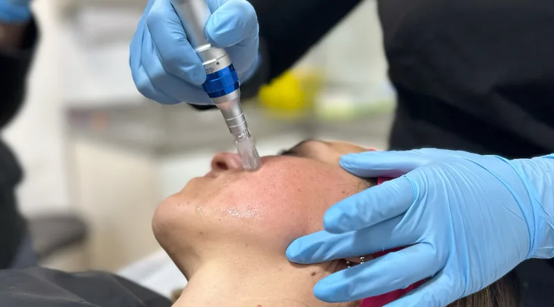 Mesoterapia facial en Providencia: Hidratación profunda 1 mesoterapia facial en providencia