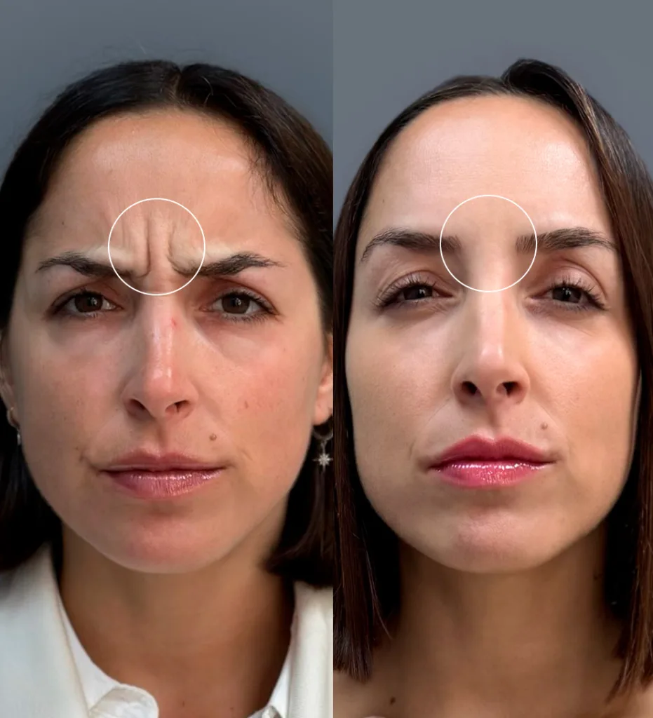 Portada AD Botox entrecejo mujer 1