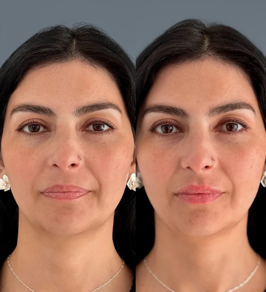 Portada AD relleno labios teoxane