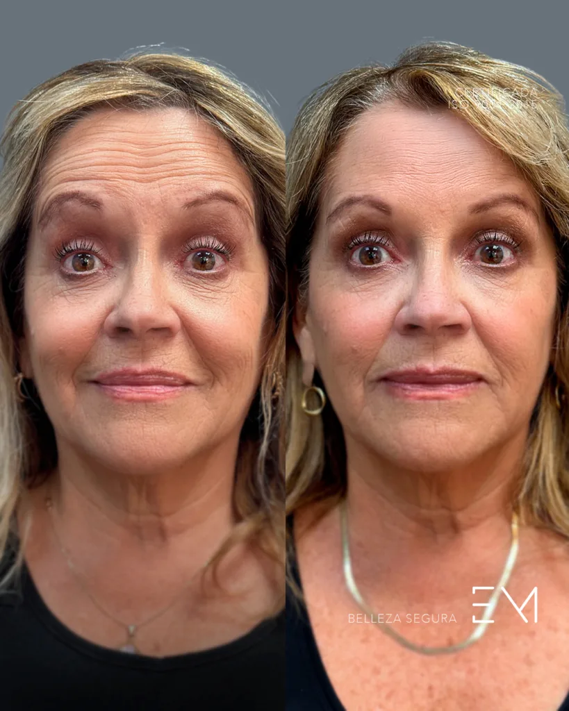 Botox en concepci&oacute;n