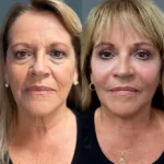 Antes y despu&eacute;s de tratamiento facial bioestimulaci&oacute;n flacidez