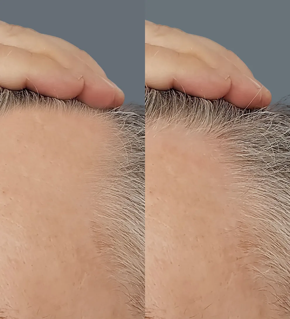 Fortalecimiento de cabello con Plasma rico en plaquetas capilar 1 Plasma rico en plaquetas capilar