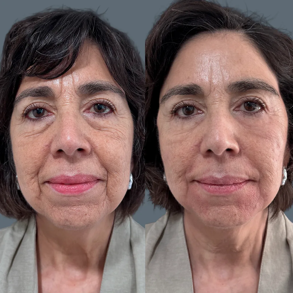 Esquema m&eacute;dico explicando flacidez, combatirla sin cirug&iacute;a mediante estimulaci&oacute;n de col&aacute;geno en la piel