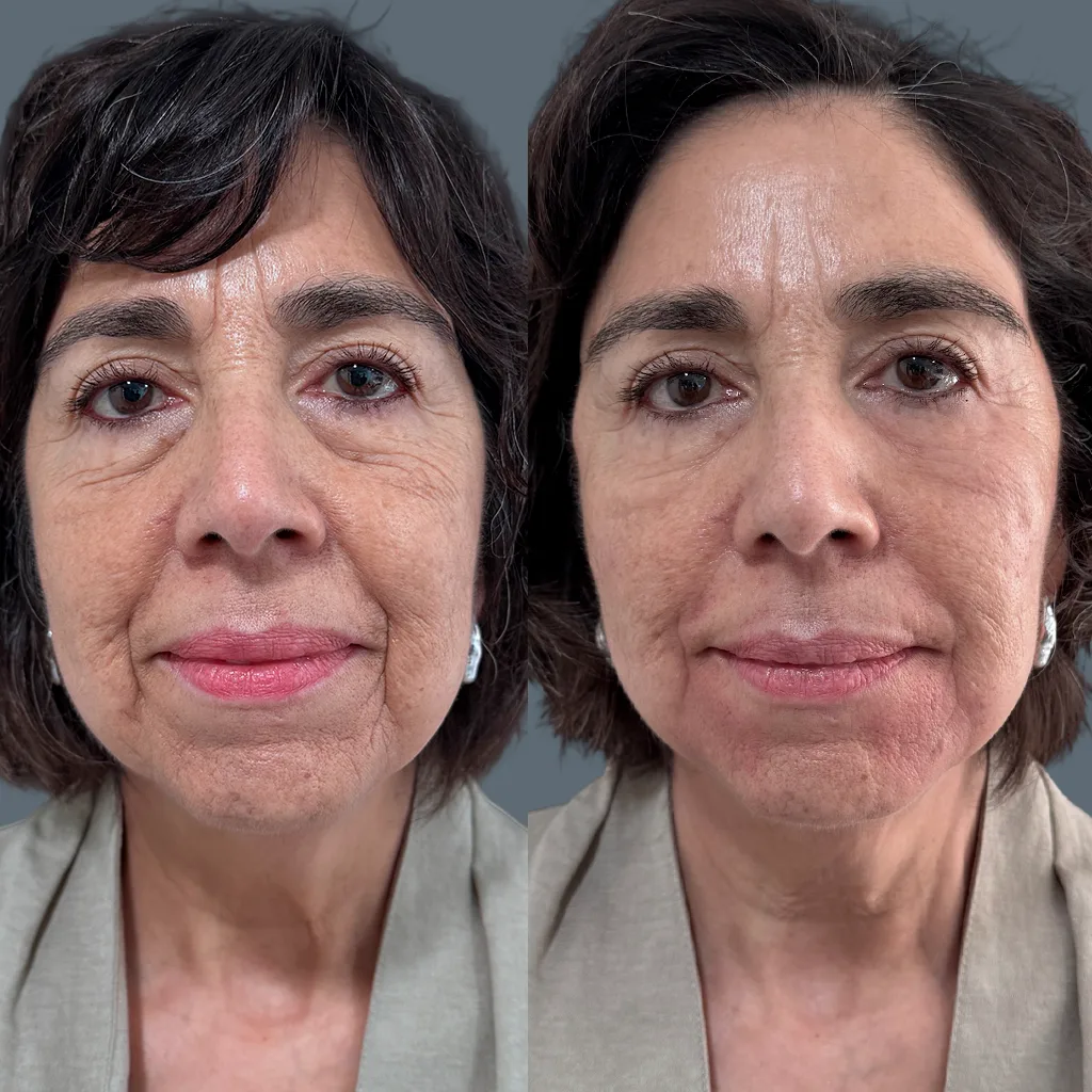 Esquema m&eacute;dico explicando flacidez, combatirla sin cirug&iacute;a mediante estimulaci&oacute;n de col&aacute;geno en la piel
