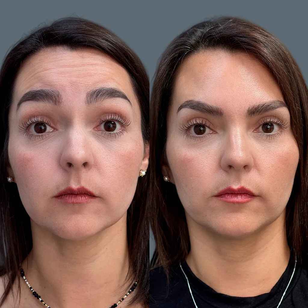Botox es el regalo n&uacute;mero 1 en navidad