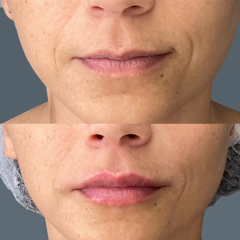 Comparaci&oacute;n cl&iacute;nica antes y despu&eacute;s relleno &aacute;cido hialur&oacute;nico en surcos faciales con enfoque en resultado natural y seguro.
