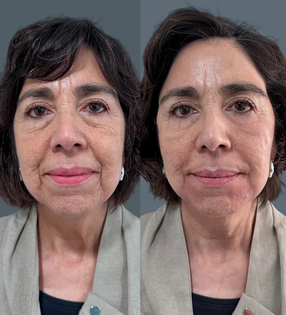 Bioestimulaci&oacute;n facial Juvelook Volume&reg;